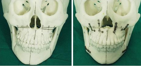 双鄂手术头骨模型