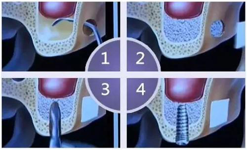 种植牙骨粉骨膜种植牙植入过程