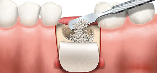 种植牙骨粉骨膜植入