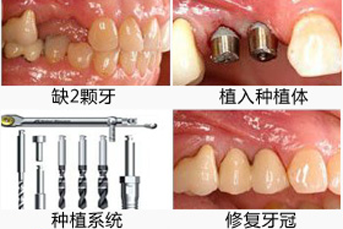 兰州哪家口腔医院种植牙技术好?种植牙报价多少钱一颗?