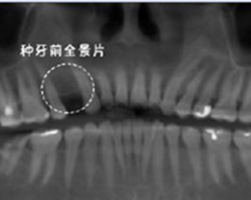 正規(guī)種牙一顆需要多少錢？