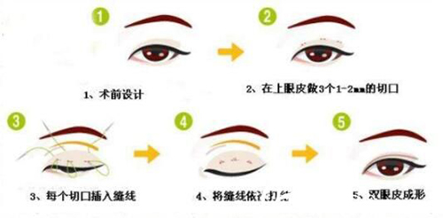 定位双眼皮手术过程