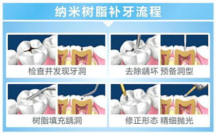 纳米树脂补牙流程