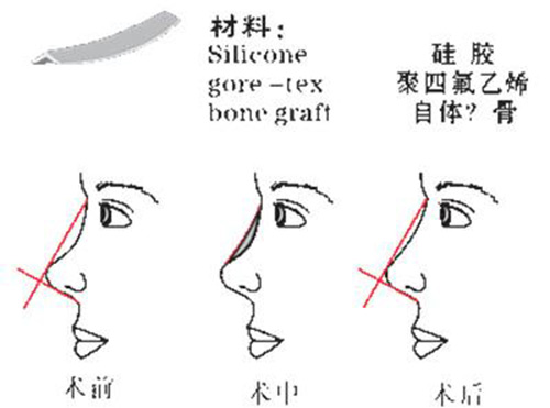 硅胶隆鼻材料示意图