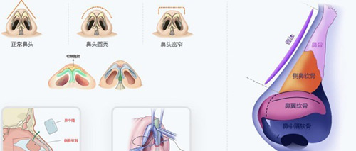 硅胶假体隆鼻示意图