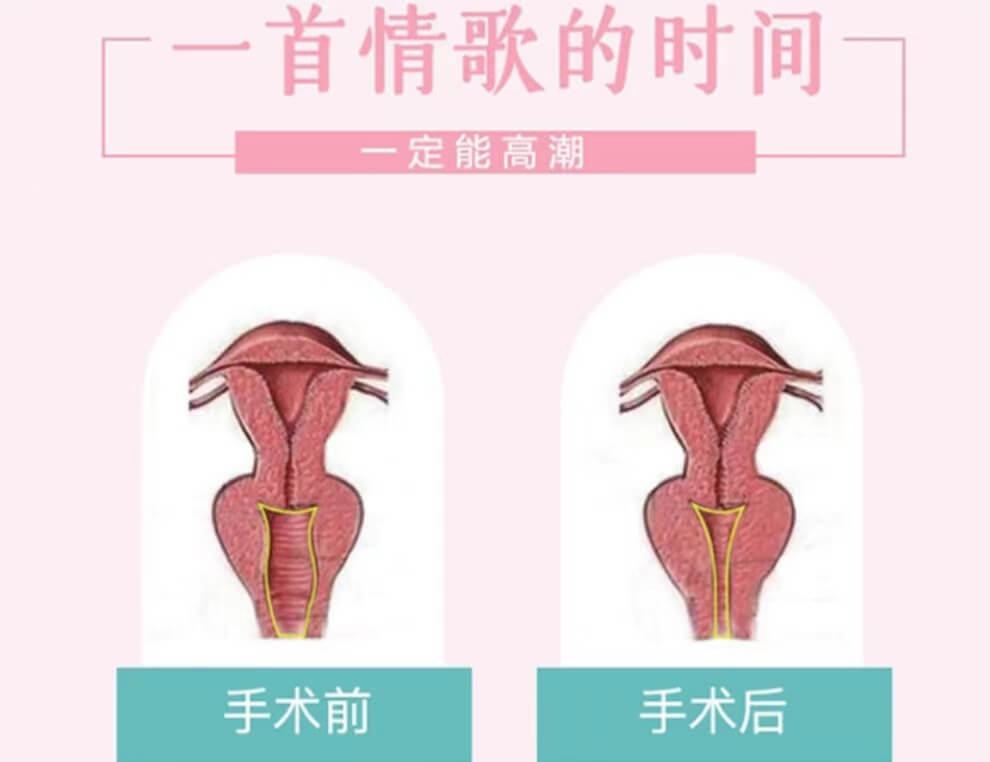 南昌美人春医疗美容阴道紧缩术<span style=