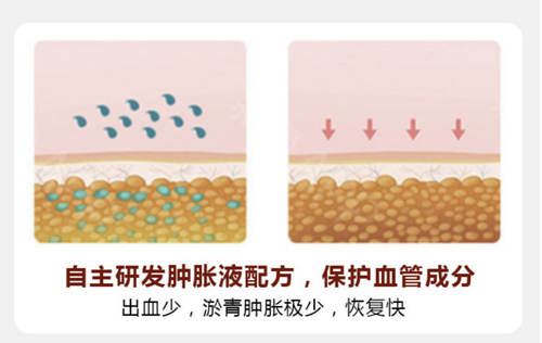 吸脂手術(shù)前后對(duì)比