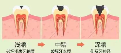 牙齿龋坏程度