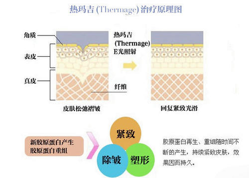 热玛吉五代有1200发吗?和900发区别是什么?和四代作用一样吗?