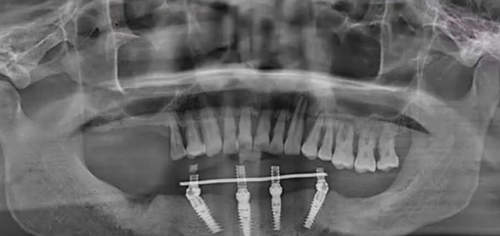 全口種植牙影像圖