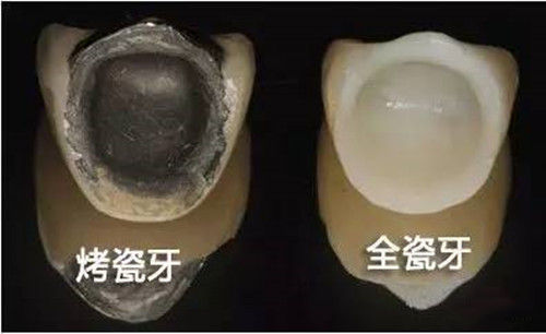 牙齿内侧掉了一小块怎么办？牙齿修复有哪些方法？