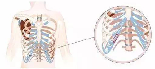 肋软骨取出部位