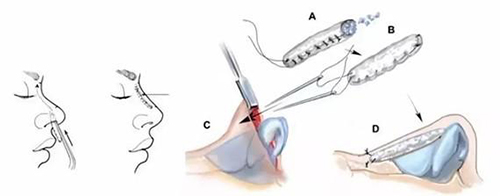 肋软骨隆鼻过程
