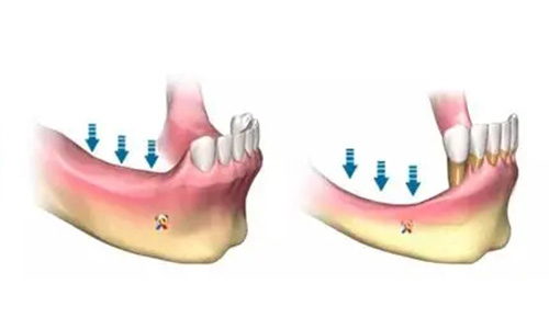 牙齿缺失牙龈萎缩示意图
