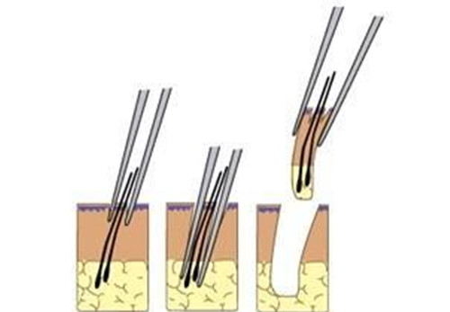 植发取用毛囊单位示意图