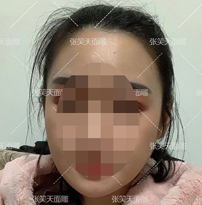 北京张笑天磨骨手术正面术后照片