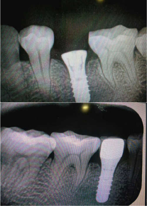 单颗种植牙植体+牙冠CT对比