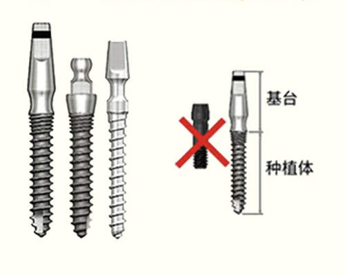 种植牙手术方式基台种植体