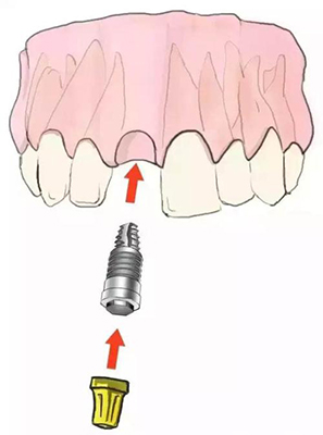 种植牙结构