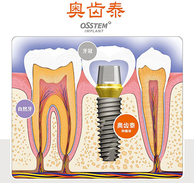 韓國奧齒泰(Osstem)種植牙