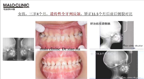 郑州马泷齿科儿童牙齿矫正怎么样