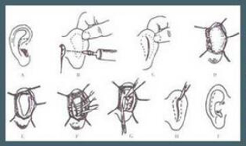 耳朵整形手术方案