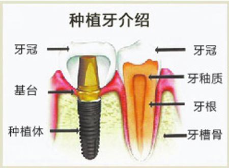 種植牙結(jié)構(gòu)