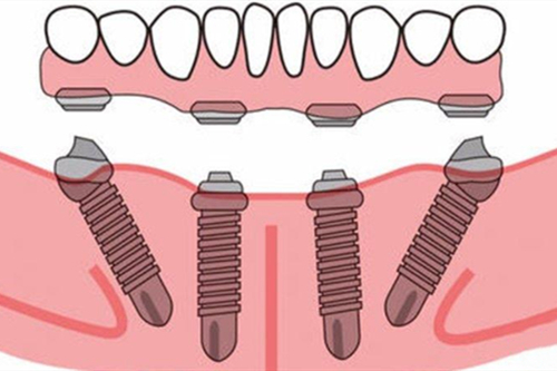 All-on-4即刻种植图示