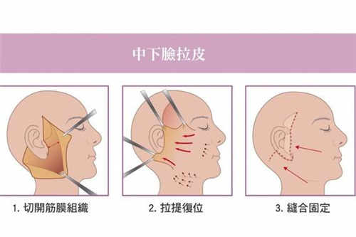 小拉皮和大拉皮手术有什么区别？哪个皮肤松弛快？