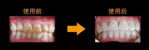 二氧化锆瓷牙使用前后对比
