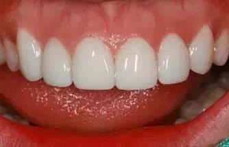 二氧化锆全瓷牙美白牙齿