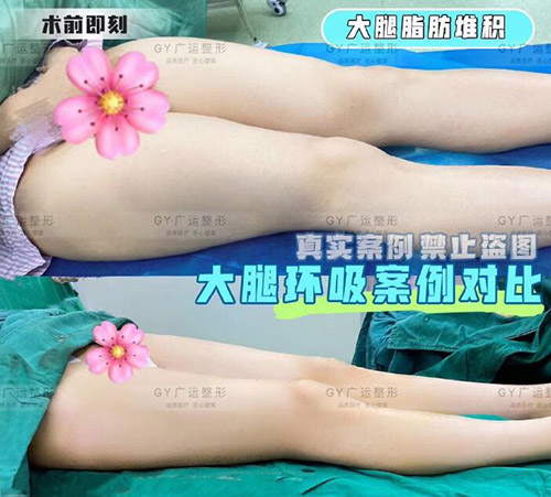 郑州广运整形医院大腿吸脂照片