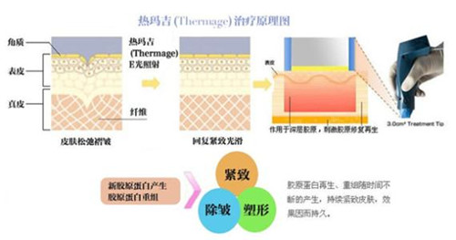 熱瑪吉的治療原理圖