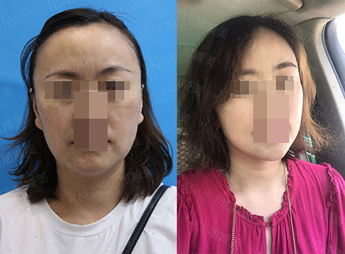 北京加减美医疗美容门诊部拉皮手术对比照片