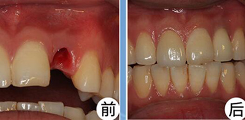 种植牙前后对比照片