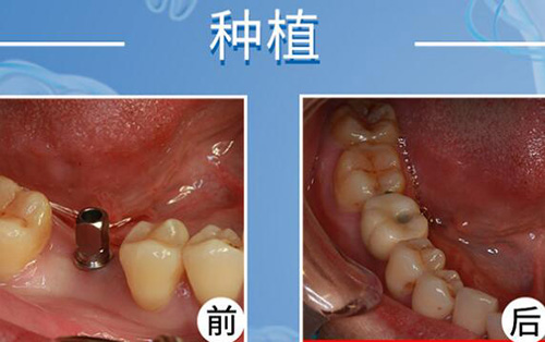 东莞仁华口腔种植改善照片