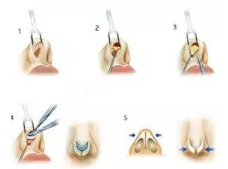 隆鼻手术过程图