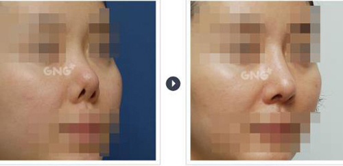 韩国GNG整形医院挛缩鼻修复对比照片