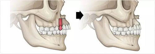 凸嘴手术截骨位置