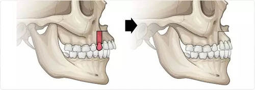 凸嘴手術(shù)截骨位置