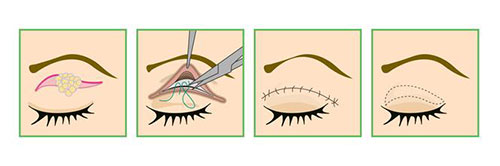 全切双眼皮过程示意图