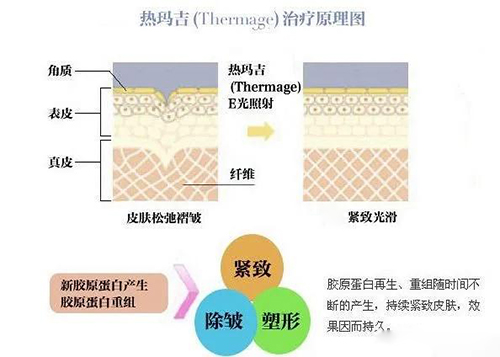 理性分析热玛吉原理和功效,看完就知道热玛吉有没有副作用!