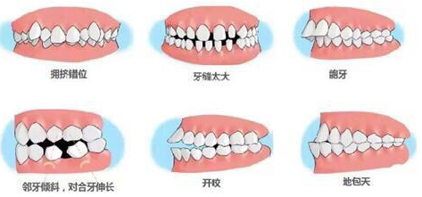 口腔牙齿矫错位图