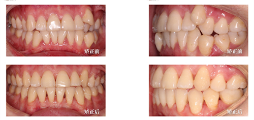 王铭淏医生牙齿矫正成果
