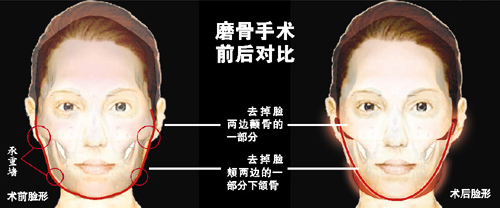 脸部磨骨手术一般多少价钱?亲身经历分享磨骨瘦脸的费用!