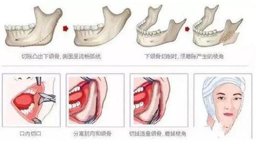 脸部磨骨手术一般多少价钱?亲身经历分享磨骨瘦脸的费用!