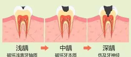 牙齒齲壞程度