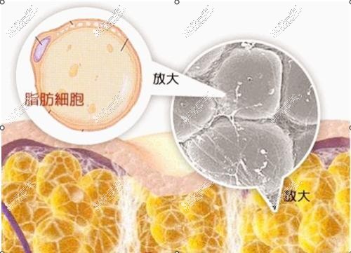 分析对比脂肪、脂肪胶和纳米脂肪填充的区别,哪个好维持久!