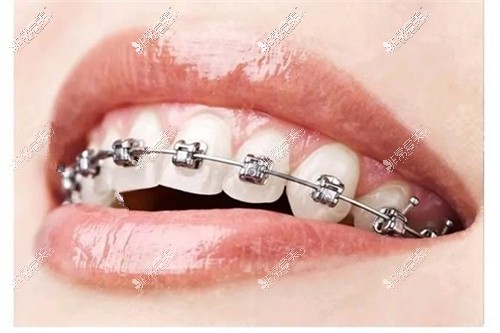 金属自锁牙套示意图