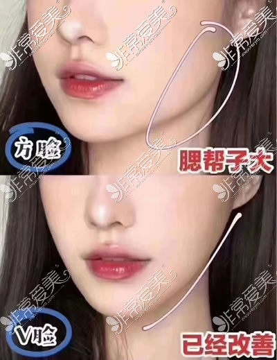 合肥华美整形外科医院瘦脸针<span style=